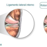 rotura_de_ligamento_lateral_interno